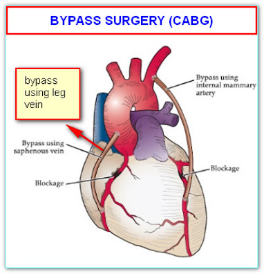 BYPASS SURGERY OR CABG SURGERY AFTER ANGIOGRAM