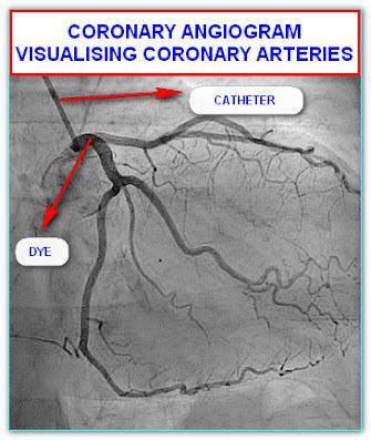 CORONARY ANGIOGRAM TEST IN HYDERABAD