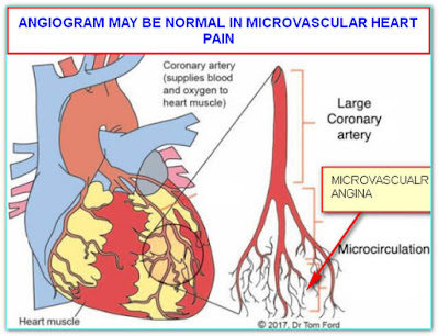 CHEST PAIN WITH NORMAL CORONARY ANGIOGRAM