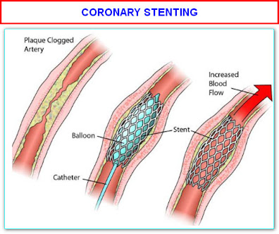 CORONARY ANGIOPLASTY OR STENT SURGERY