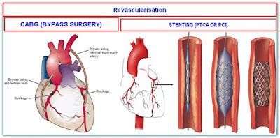 Management plan for coronary artery disease-CABG surgery and heart stent surgery