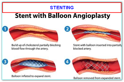 HOW STENT WORKS