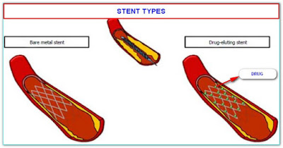BARE METAL STENT AND DRUG ELUTING STENT