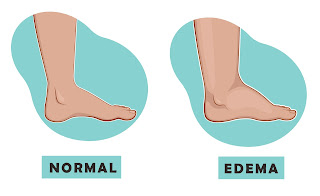 SWELLING OF A LEG IS COMPARED WITH A NORMAL LEG