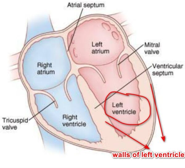 Rwma In 2d Echo Means Heart Specialist Hyderabad